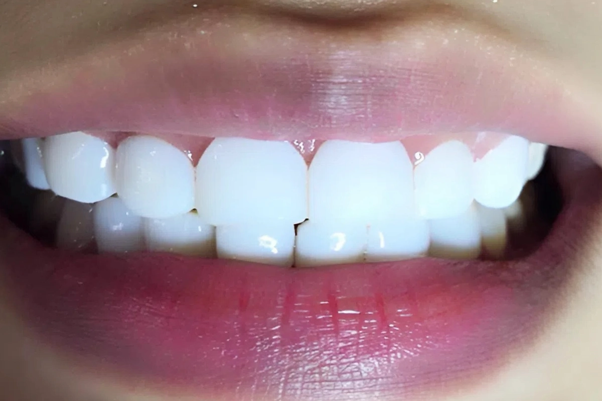 Lớp phủ sứ nano thô dày, thiếu sự tinh xảo như răng bọc sứ hay dán Veneer